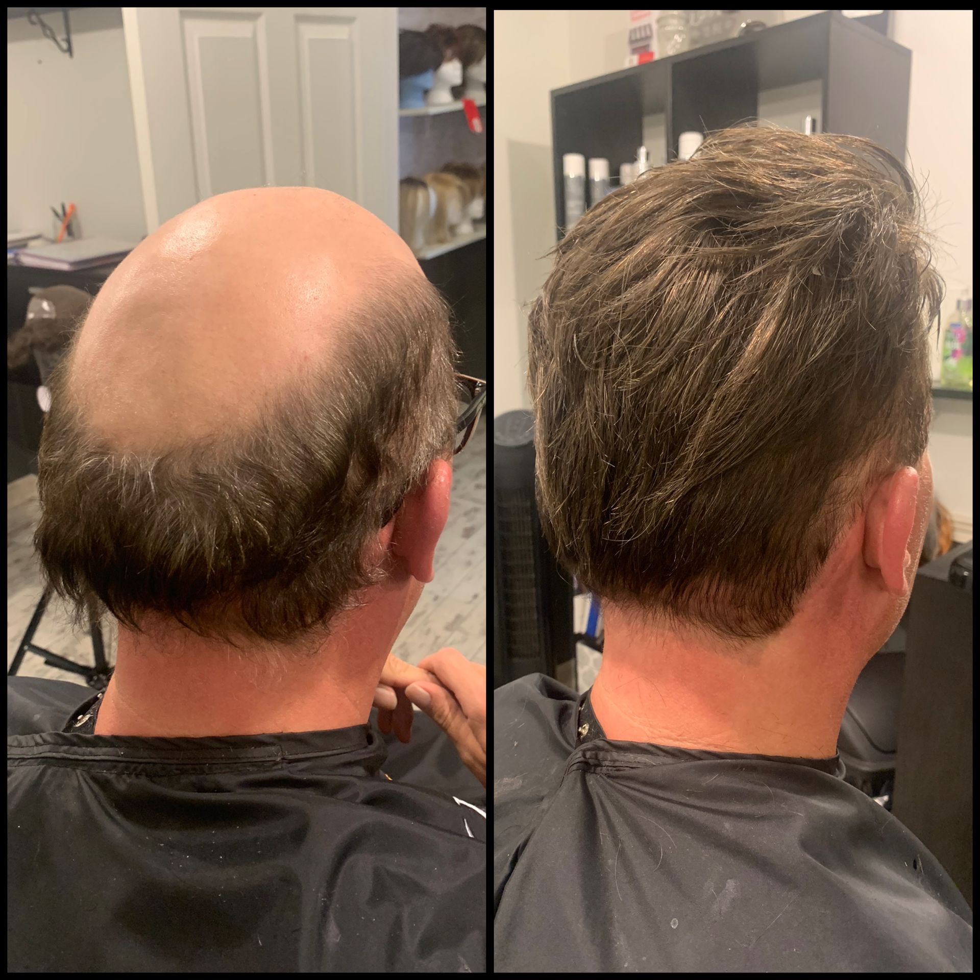 Back view comparison: bald crown before and after hair restoration in a salon chair