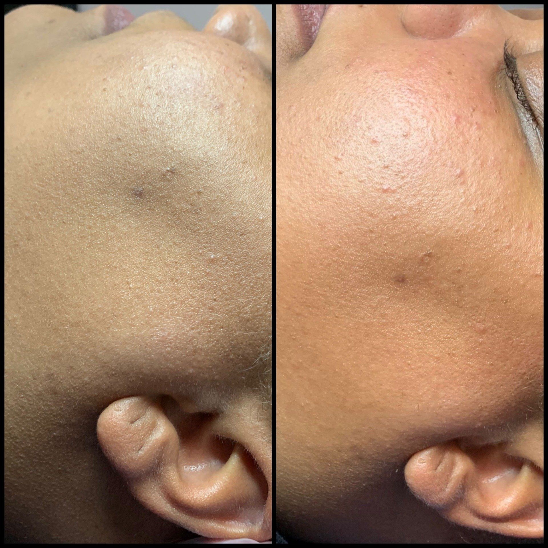 Side-by-side close-ups of a cheek showing before-and-after skin texture and tone