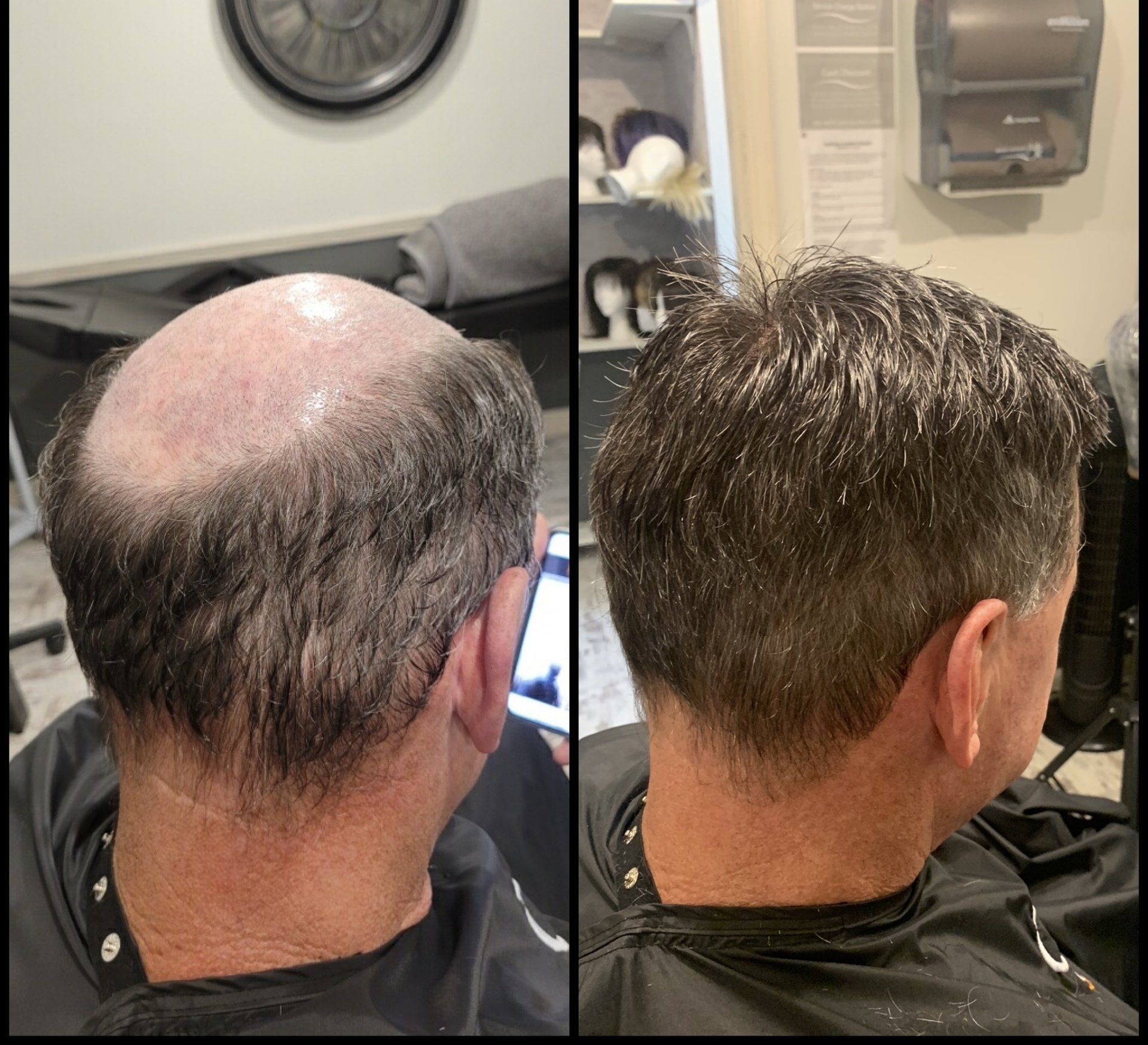 Before and after view of a short gray haircut, showing a bald crown on the left and fuller hair on the right