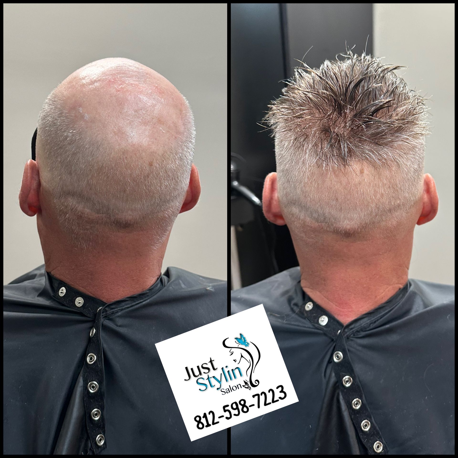 Before-and-after hair restoration: bald scalp with thin spiky regrowth, back view in salon chair.