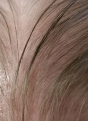 Close-up of a scalp with light brown hair and a small red irritated patch