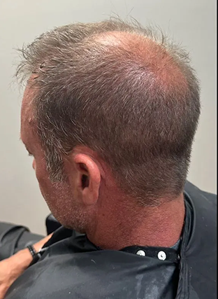 Back view of a man’s head showing significant hair thinning and a pink scalp.