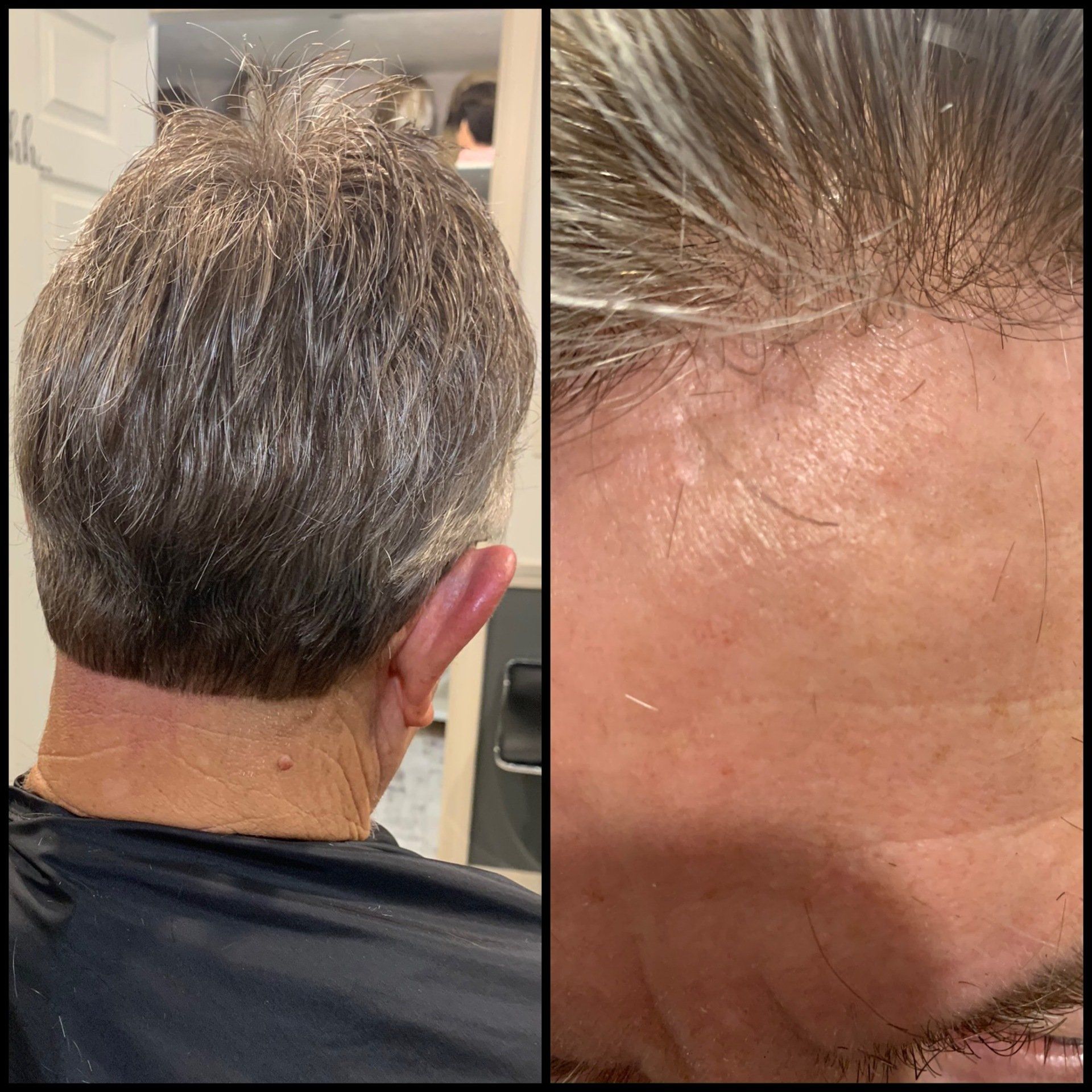 Back of a person’s head beside a close-up of their thinning hairline and scalp