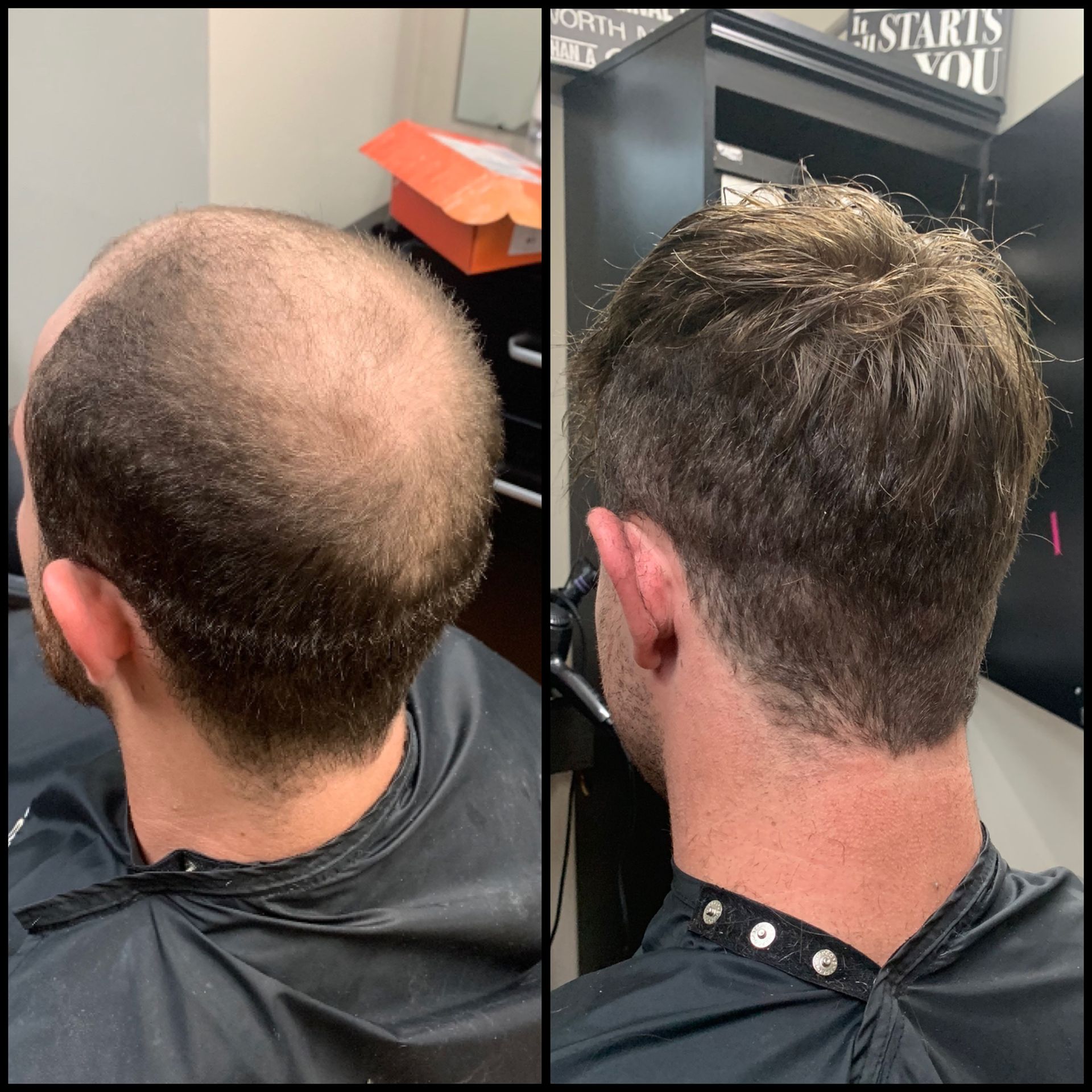 Before-and-after haircut showing a balding scalp on the left and a shorter, textured cut on the right.